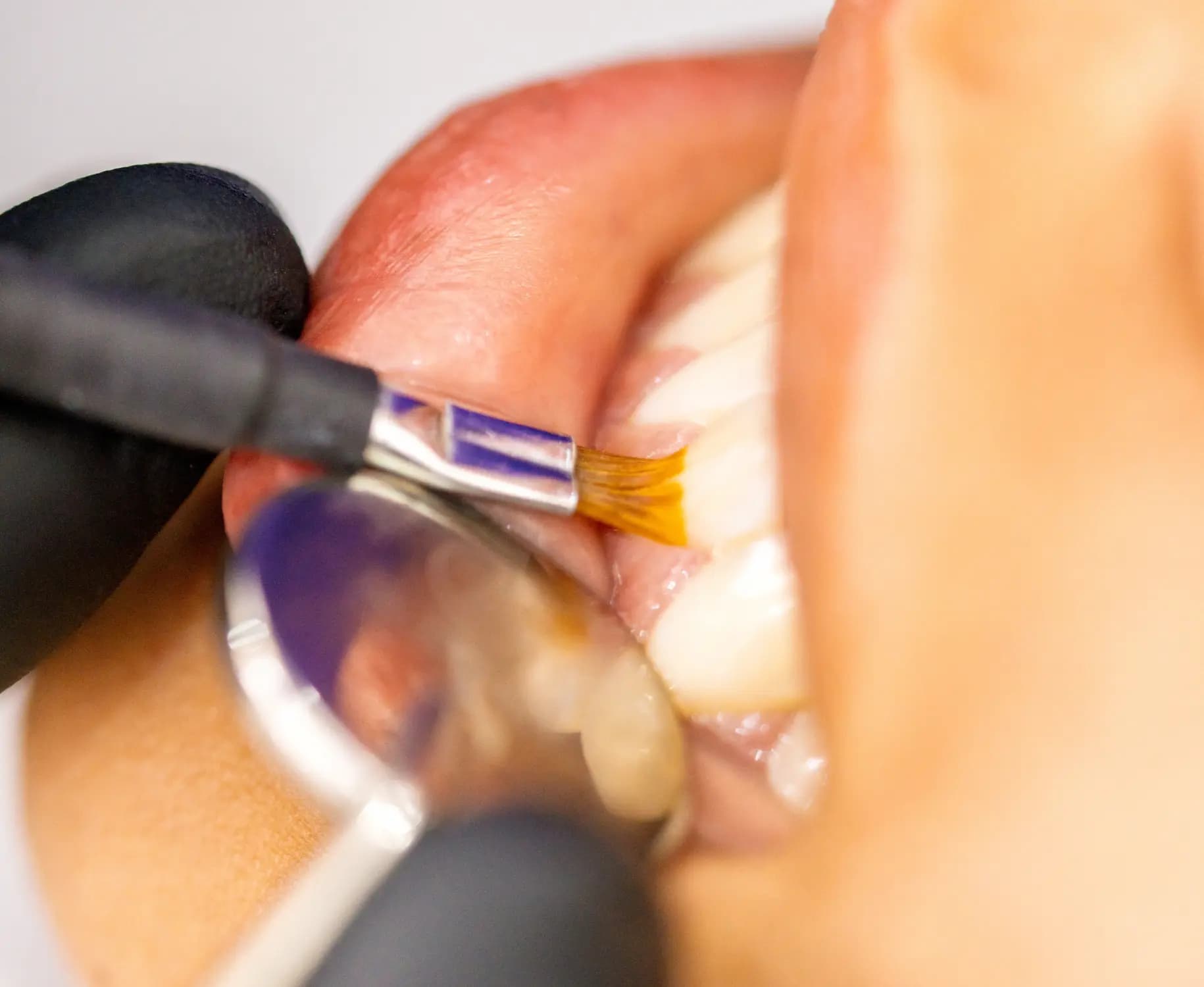 Close-up of a small brush applying fluoride to a patient's teeth beside a dental mirror