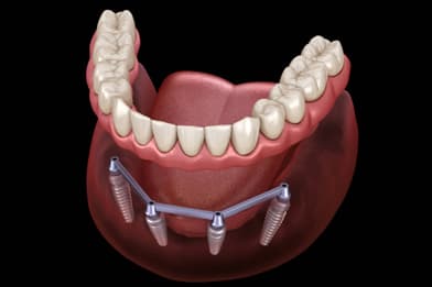 Illustration of a full-arch denture supported by four dental implants in the lower jaw