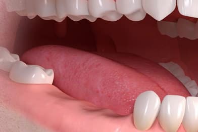 Illustration of a lower jaw missing several back teeth, a gap an implant bridge can fill