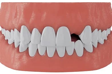 Dental illustration of a smile with one missing upper tooth that a single dental implant can replace