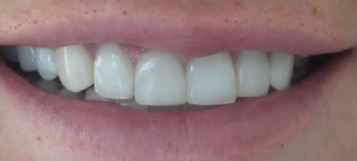 Smile after a makeover at Alpine Dental in Burke, VA, with bright, white, evenly shaped teeth