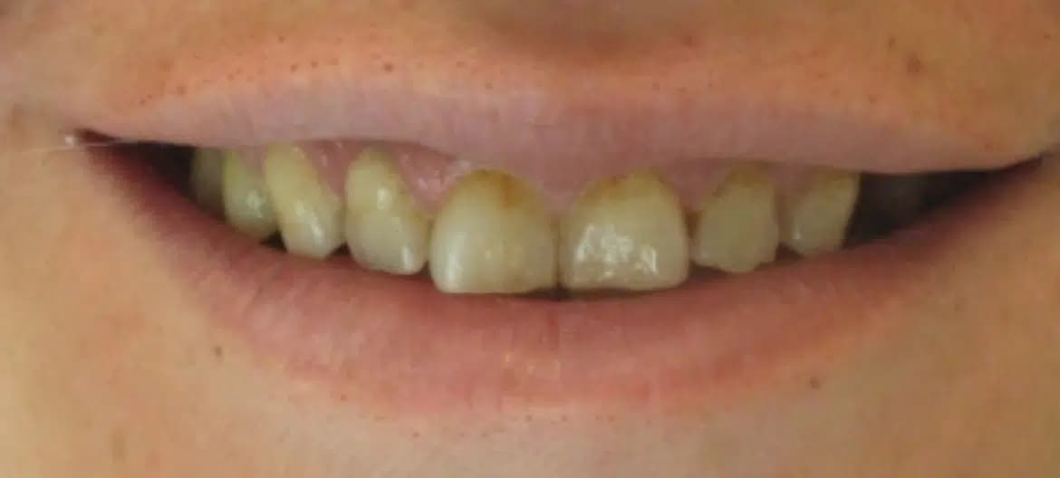 Smile before a makeover at Alpine Dental in Burke, VA, with yellowed and uneven teeth