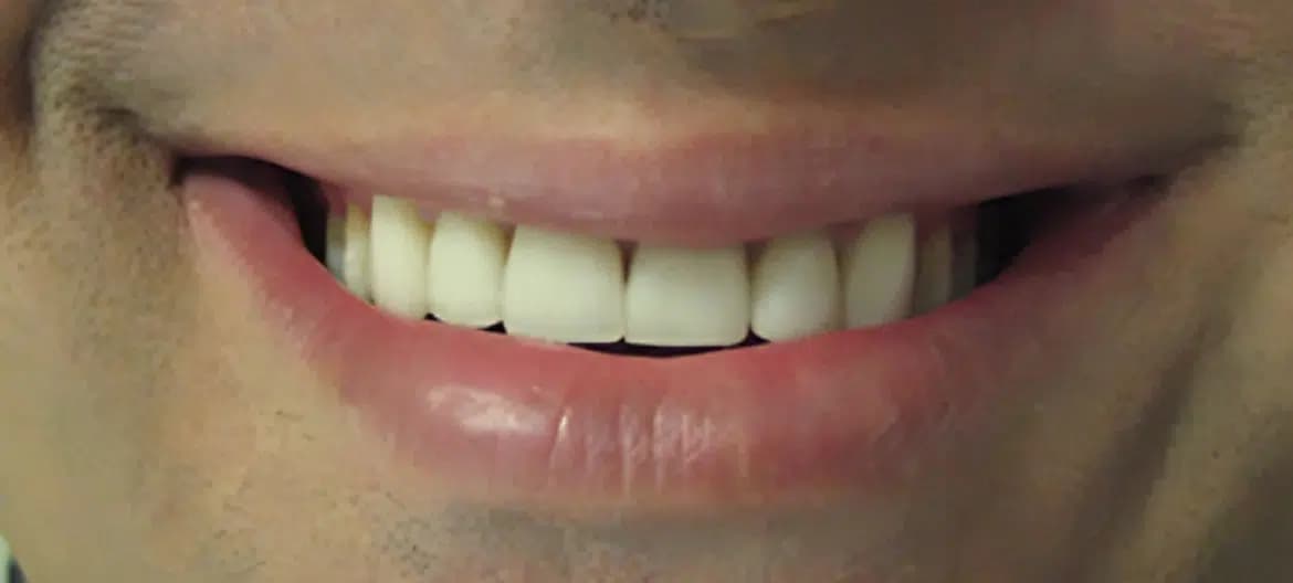 Same smile after cosmetic treatment at Alpine Dental in Burke, VA, with even, repaired front teeth