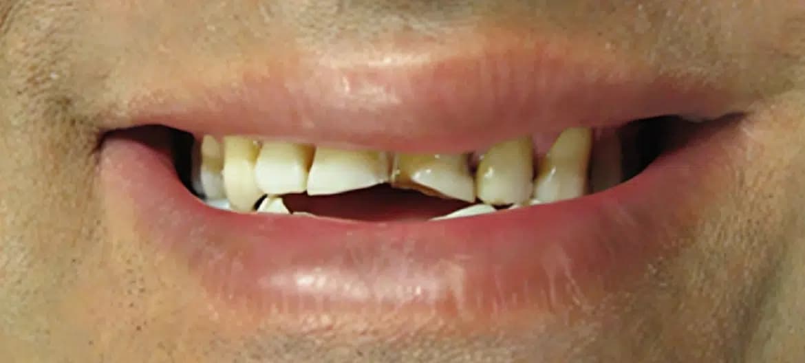 Smile before treatment at Alpine Dental in Burke, VA, with chipped and uneven front teeth