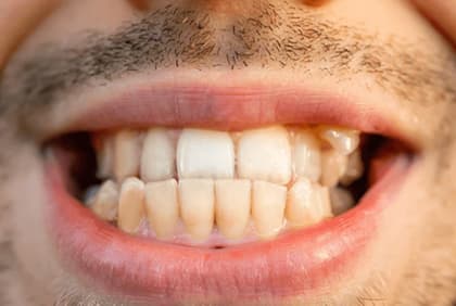 Close-up of a man's teeth showing uneven bite alignment between upper and lower teeth