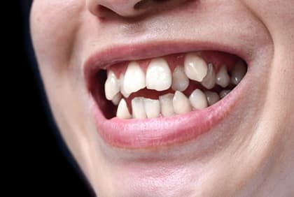 Close-up of a smile with crowded, overlapping upper and lower front teeth
