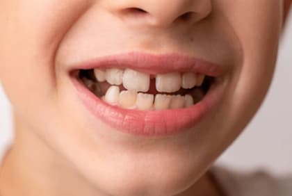 Close-up of a smile showing a noticeable gap between the upper front teeth