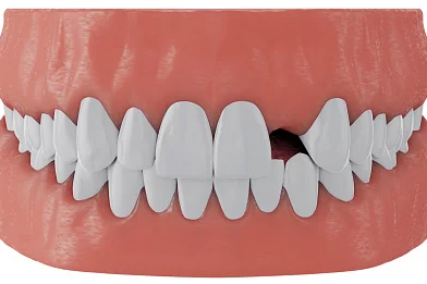 Tooth Replacement in Burke, VA