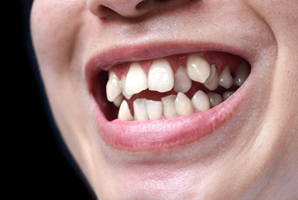 crowded teeth treatment in Burke, VA