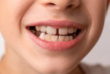gaps between teeth treatment in Burke, VA