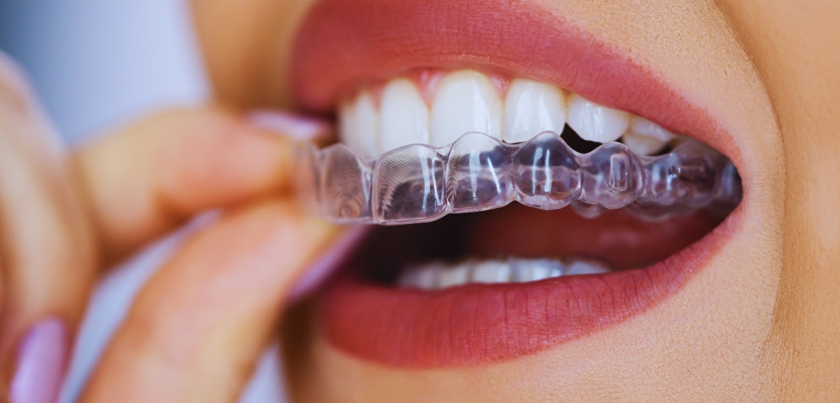 how nightguards help prevent teeth grinding damage